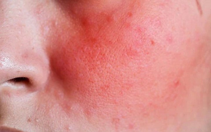 Sensitive Skin